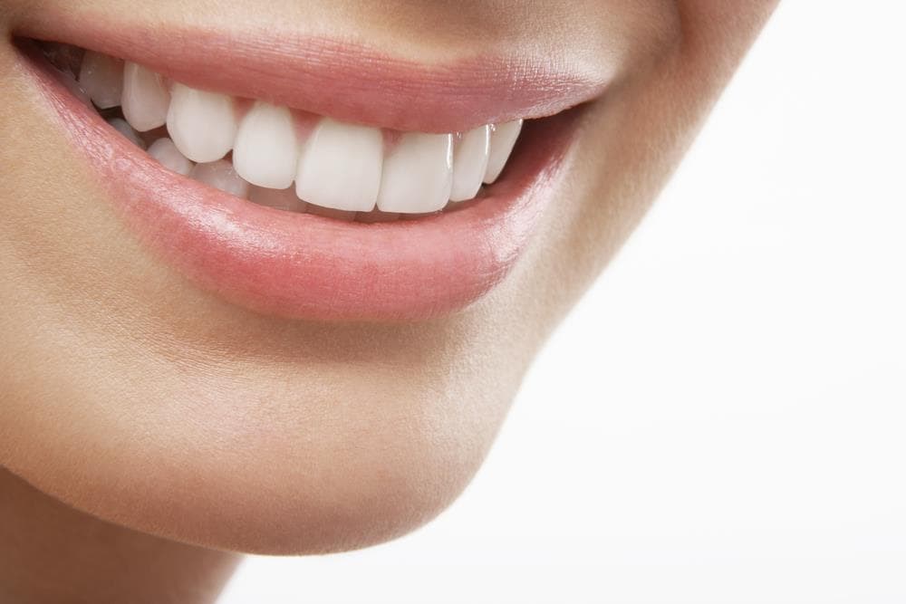 ¿Cuáles son las ventajas de las carillas dentales?