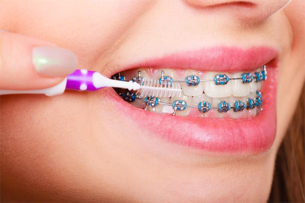 La importancia de la higiene bucal en pacientes con ortodoncia