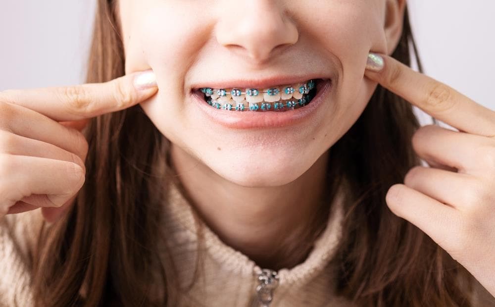 Cera para brackets: ¿cómo se utiliza?