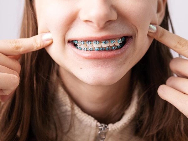 Cera para brackets: ¿cómo se utiliza?