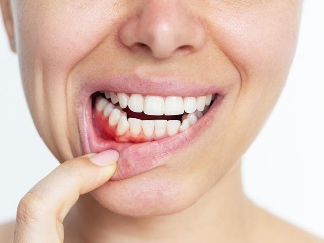 ¿Cómo tratar la gingivitis?